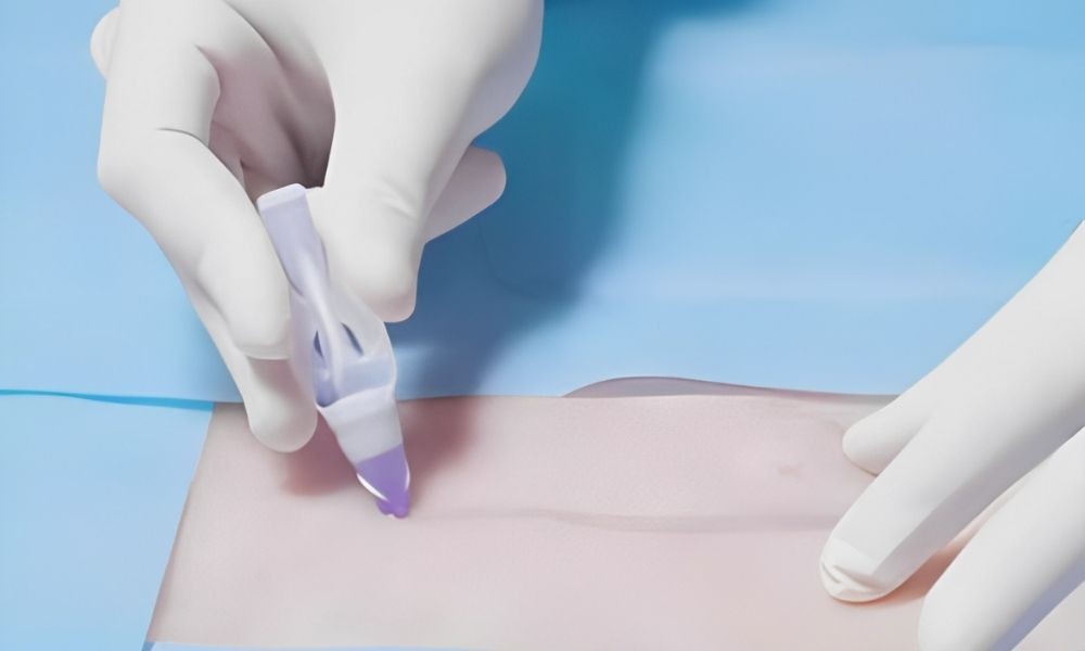 Aplicação de cola cirúrgica em cicatriz pós-operatória