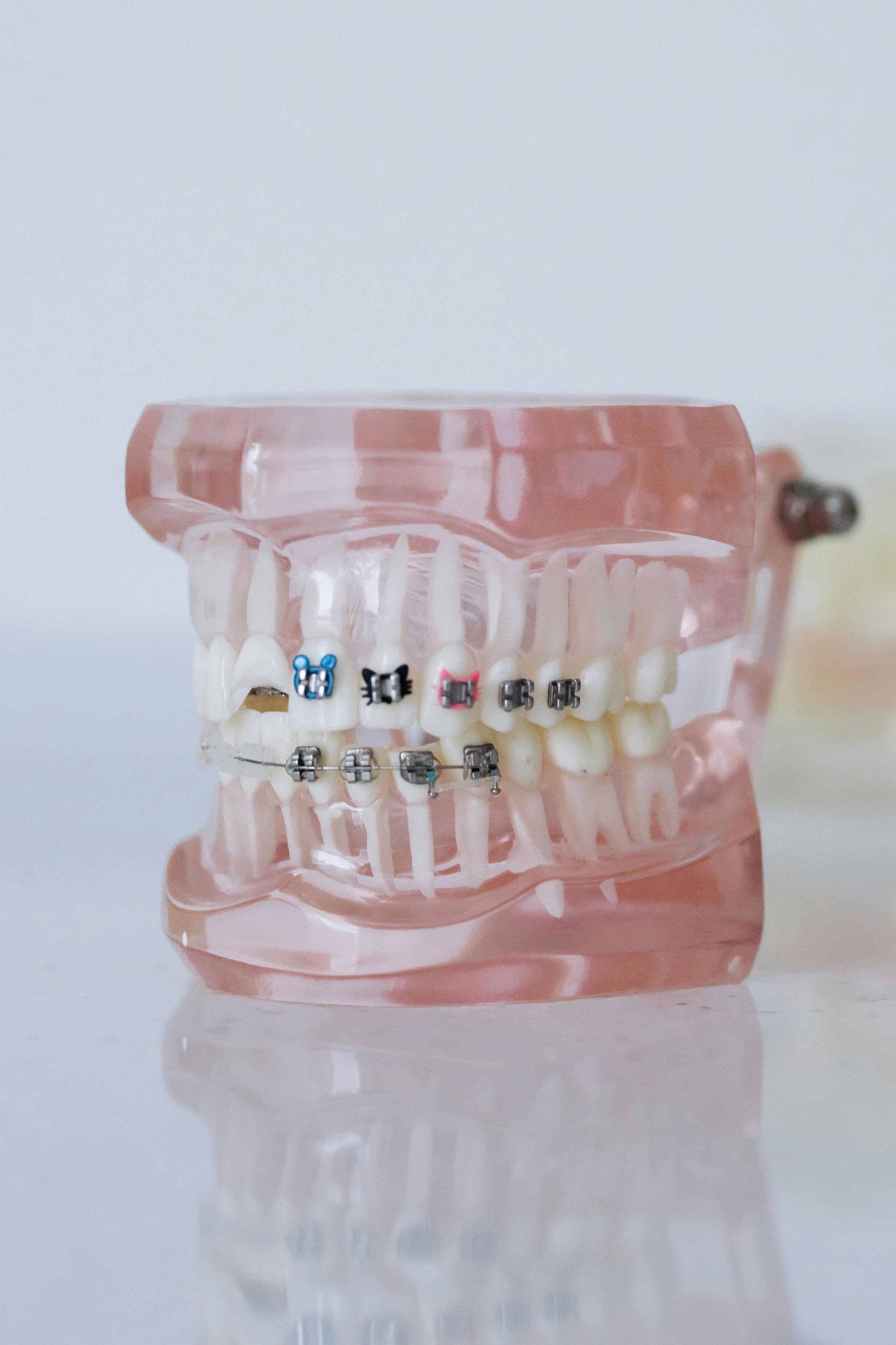 A picture of Transparent dental model displaying colorful orthodontic braces on teeth