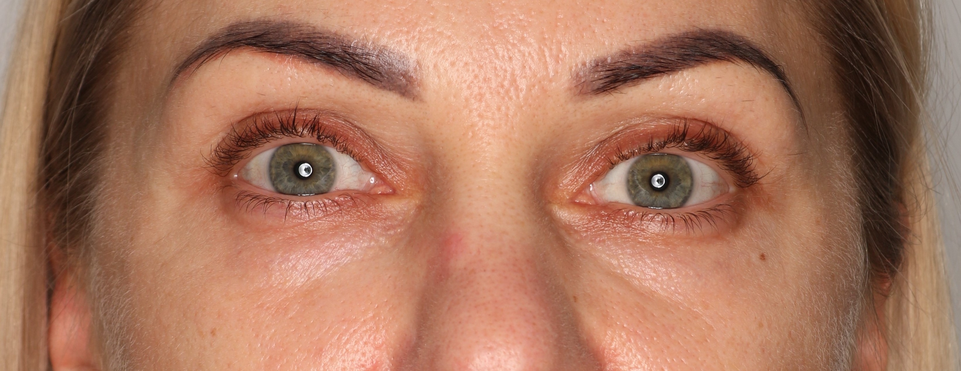 Efekt zabiegu Laser frakcyjny CO2 - Po 3