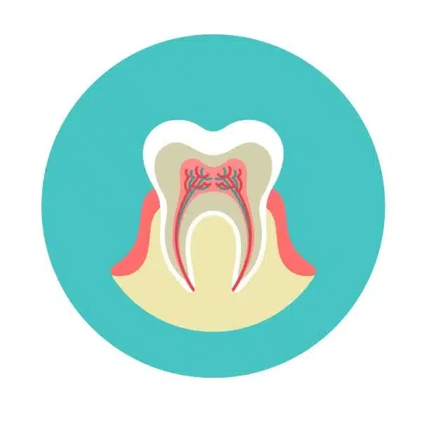 Illustration showing the stages of root canal treatment inside a tooth