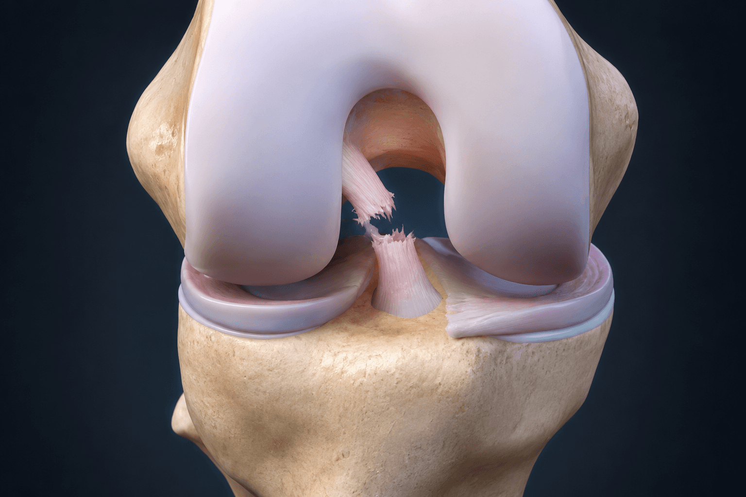 Imagem ilustrativa de joelhon com ruptura em seu ligamento cruzado anterior