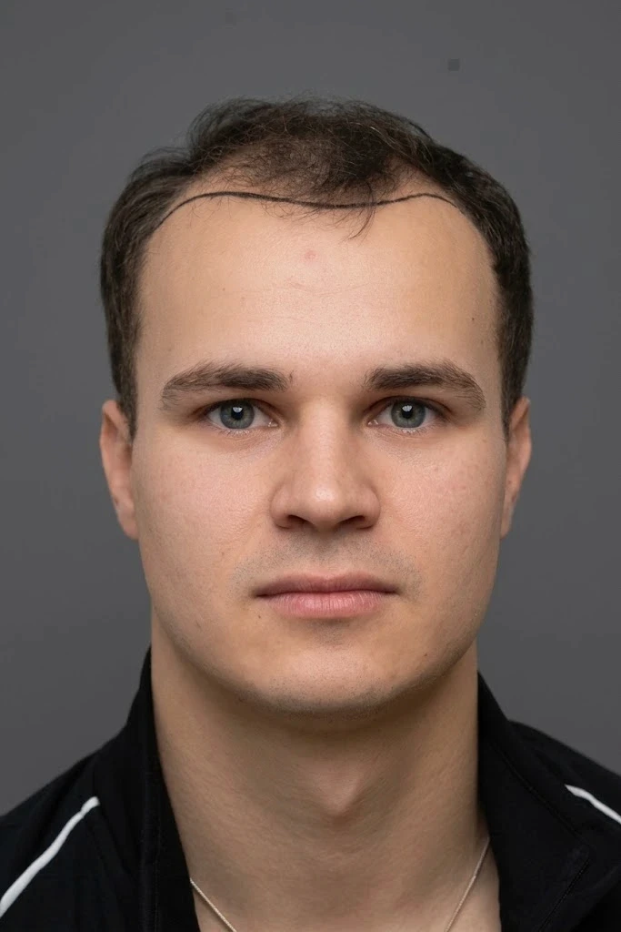 Zurückgewichener Haaransatz vor der Eigenhaartransplantation in der Partnerklinik
