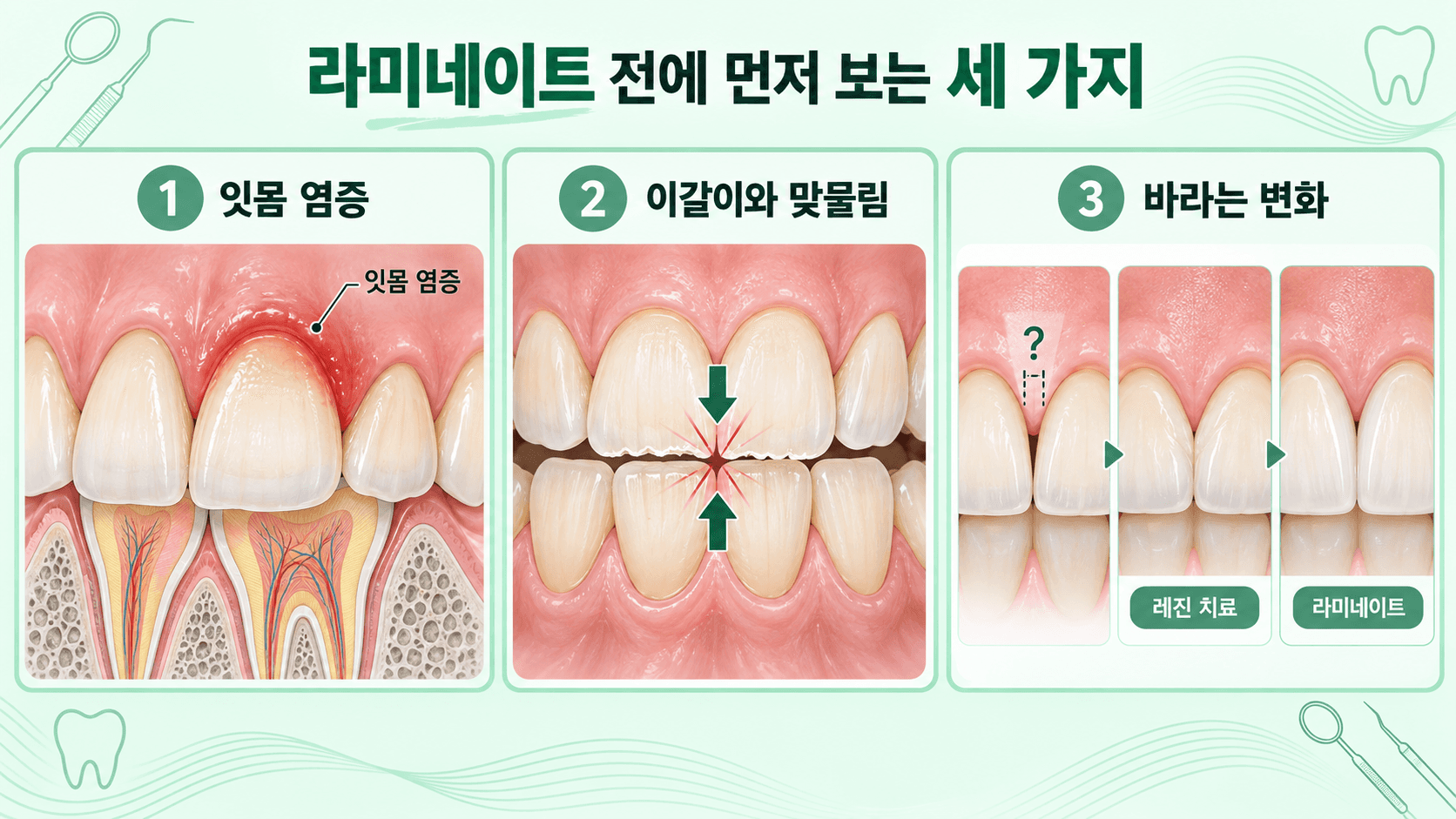 라미네이트 전에 잇몸 염증, 이갈이와 맞물림, 바라는 변화를 먼저 확인하는 세 가지 기준을 그린 일러스트