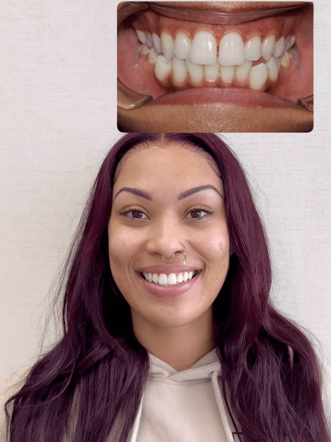 Before and After Invisalign Treatment at ScarboroSmiles Dental Clinic in Scarborough, ON | Best dentist in Scarborough. 