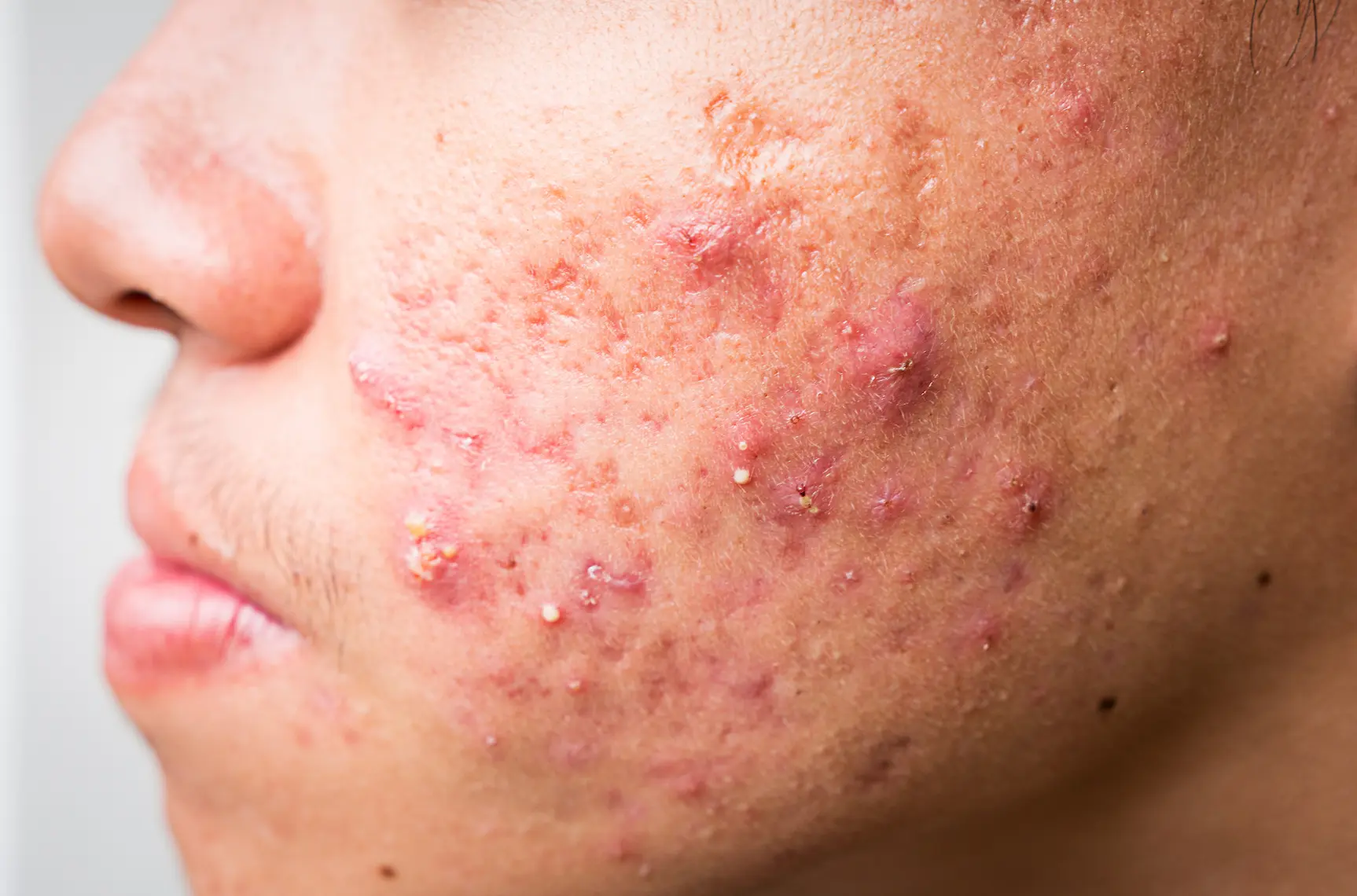 acne facials vancouver