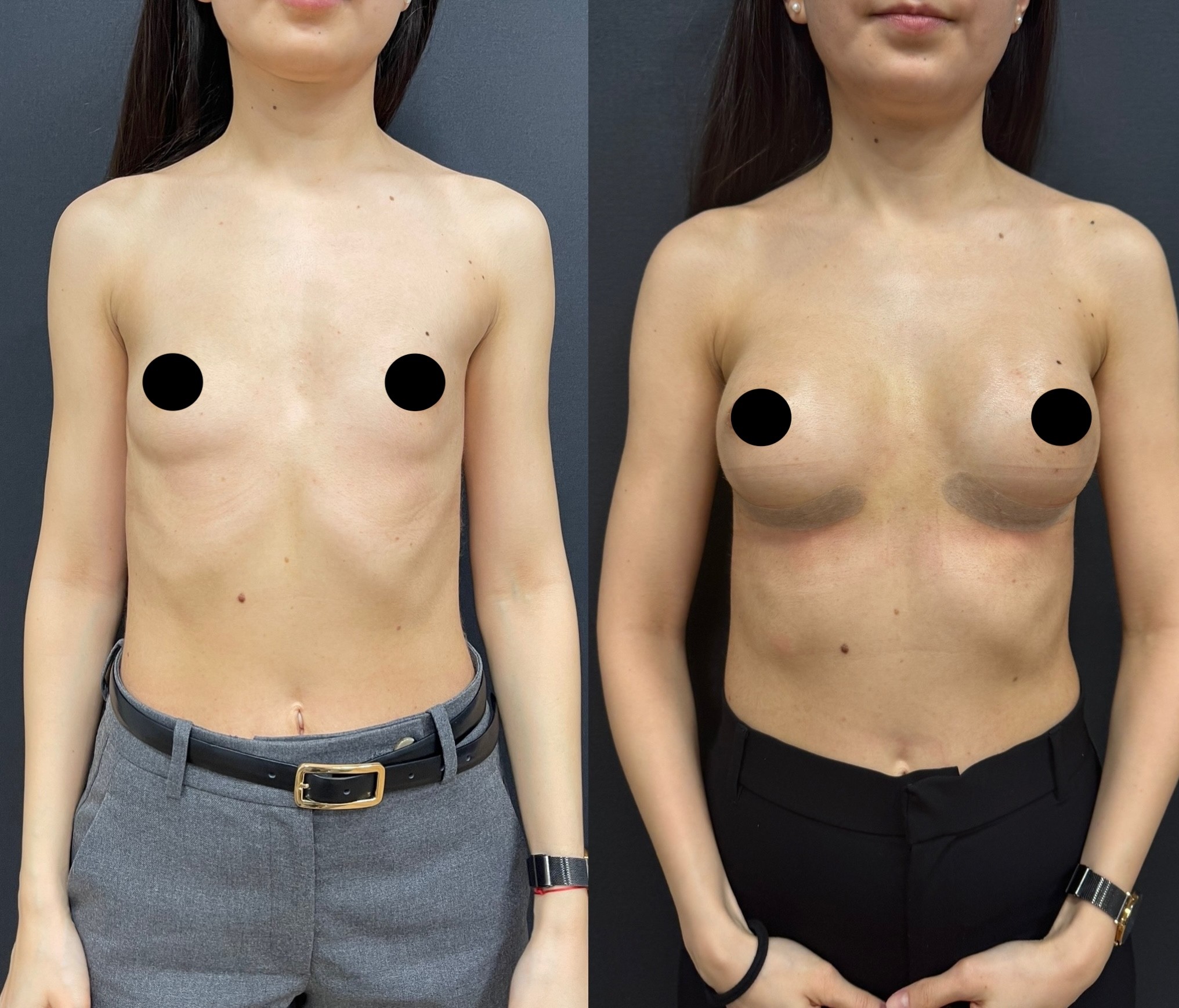 10 days breast augmentation result front view