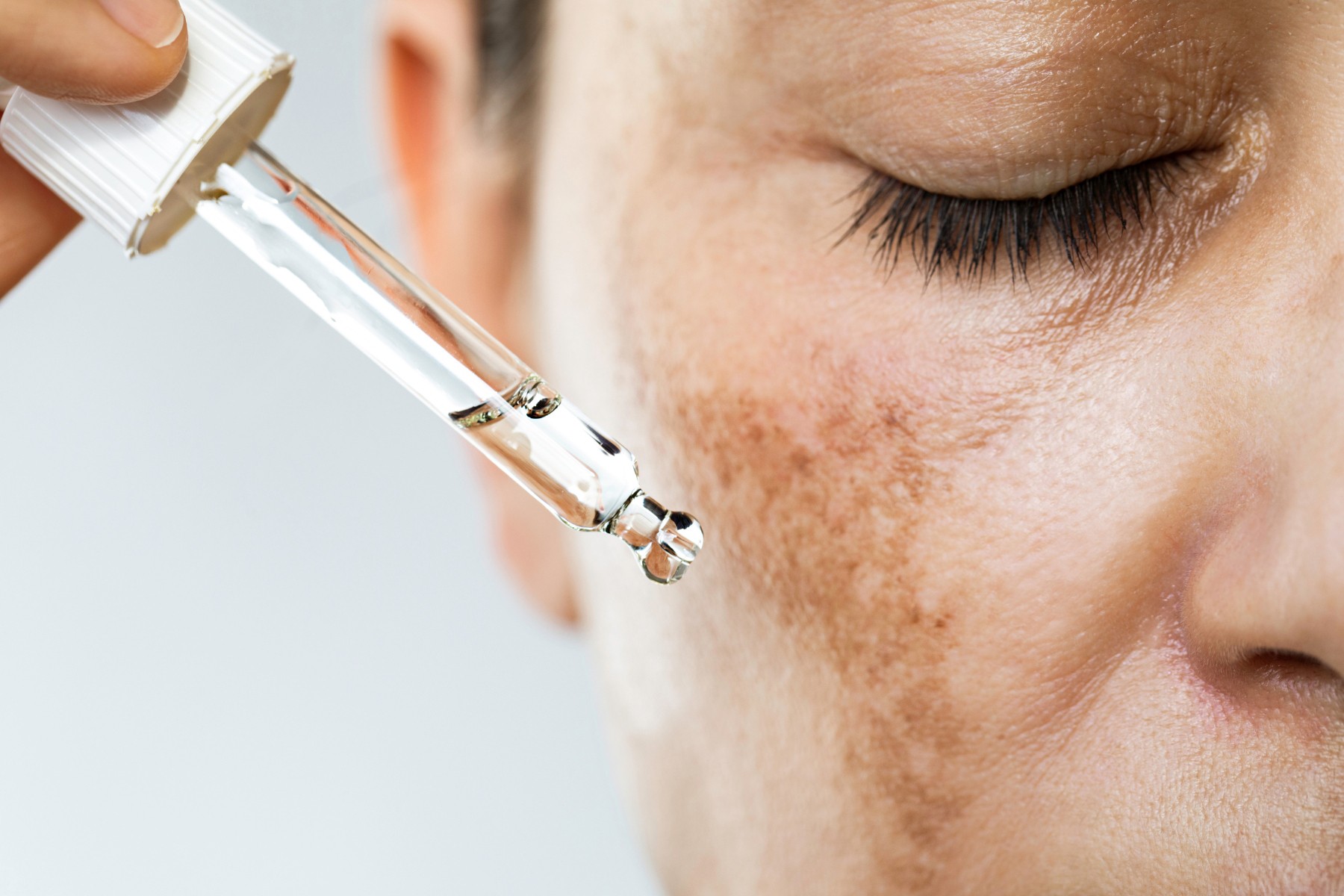 Tratamiento de melasma en Terrassa, Heaven Clinics