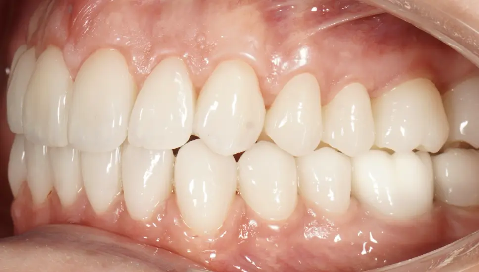 After prosthetic rehabilitation