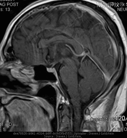 MRI image of a brain