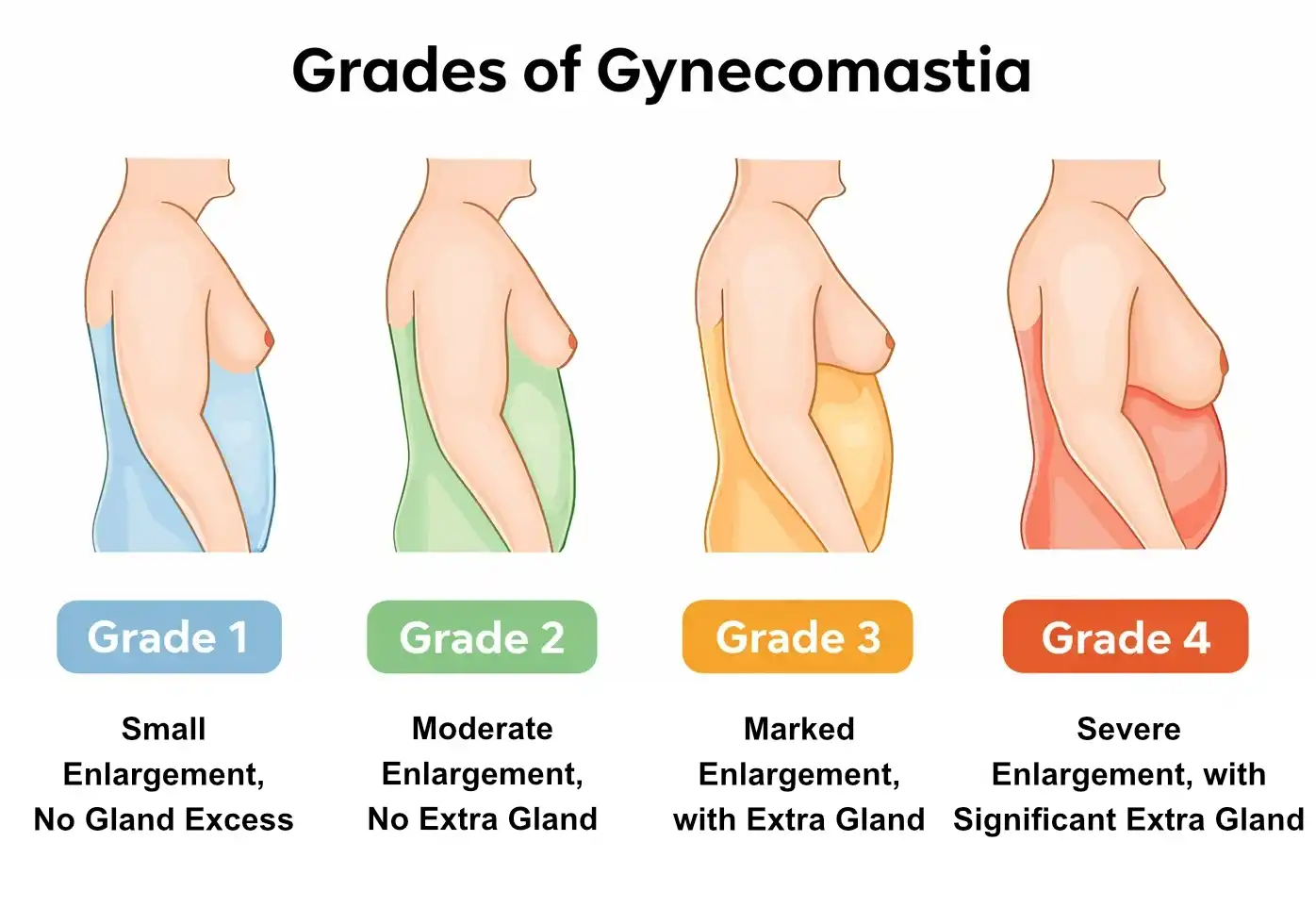 Diagram explaining excess gland and fat tissue in gynecomastia