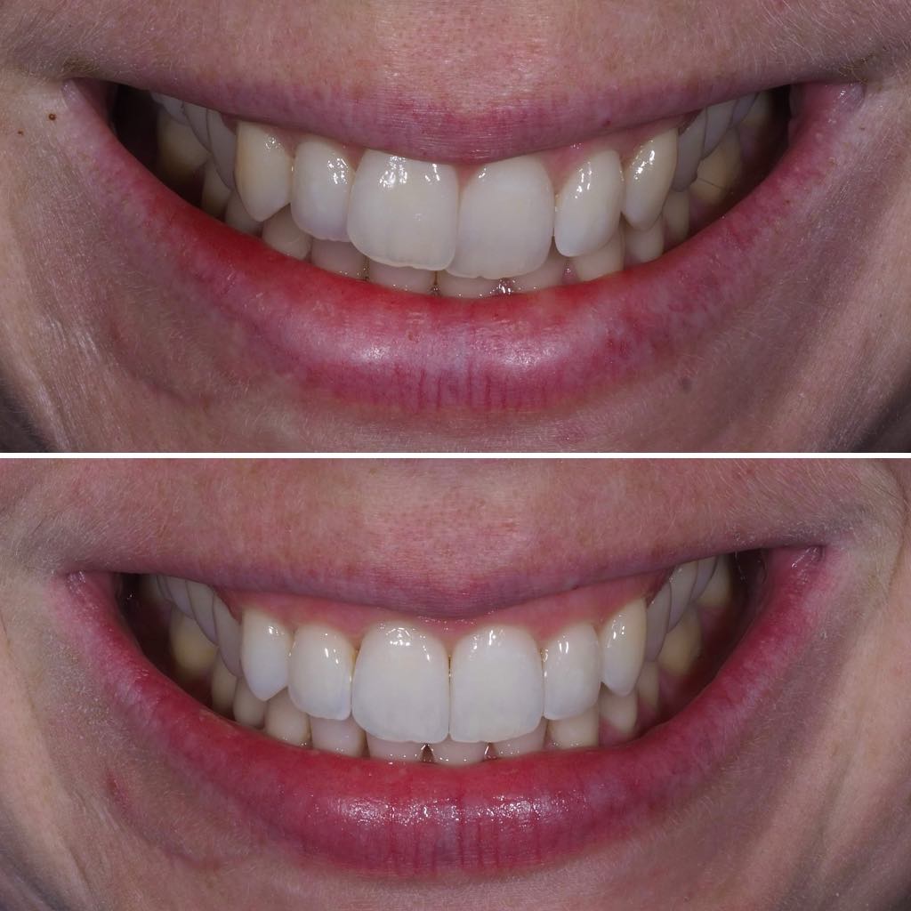 Before & After