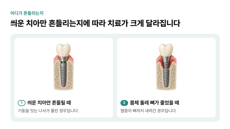 임플란트의 몸체, 기둥, 씌운 치아 구조와 나사가 풀려 씌운 치아만 흔들리는 경우, 뼈가 사라져 몸체가 흔들리는 경우를 비교한 일러스트