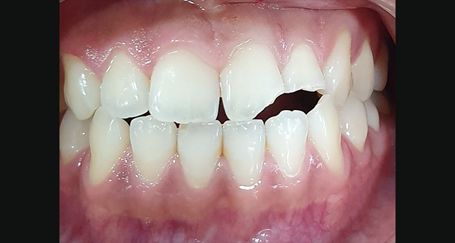 치아 파절 초진 사진