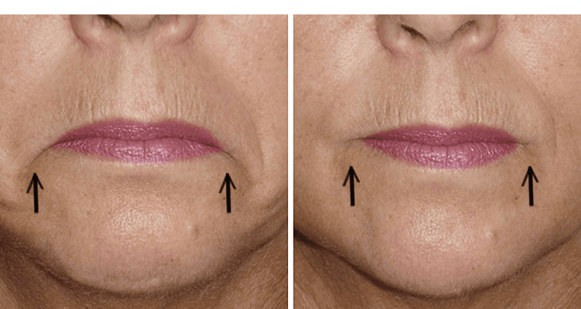 Botox Injections