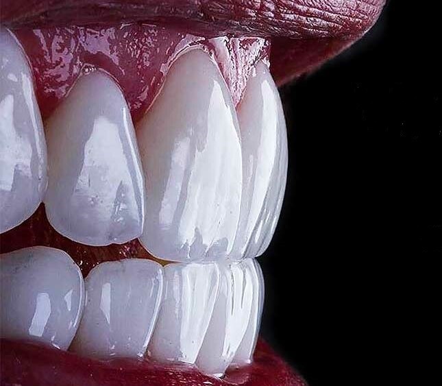 porcelain veneers in mineola