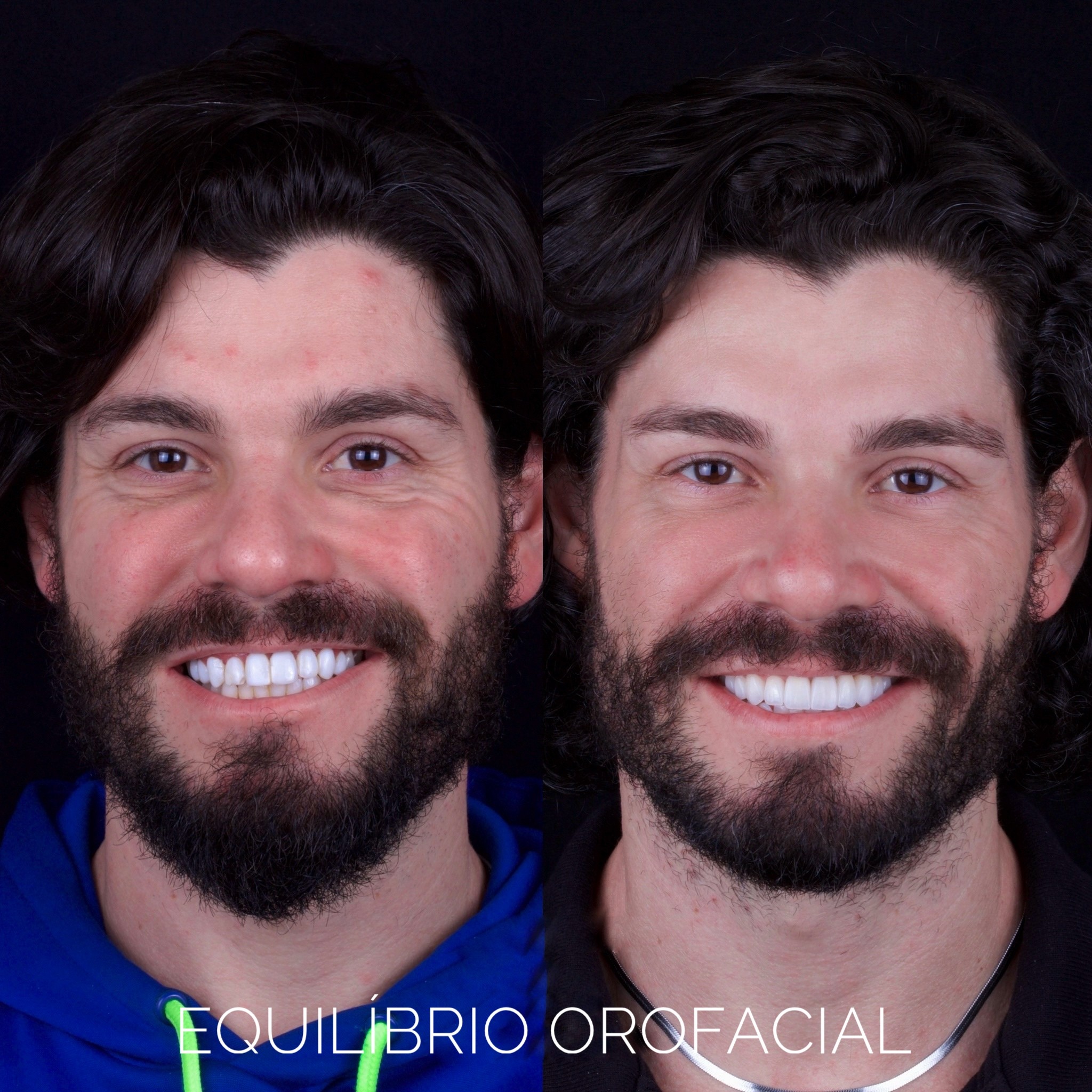 Facetas de Porcelana e Resina