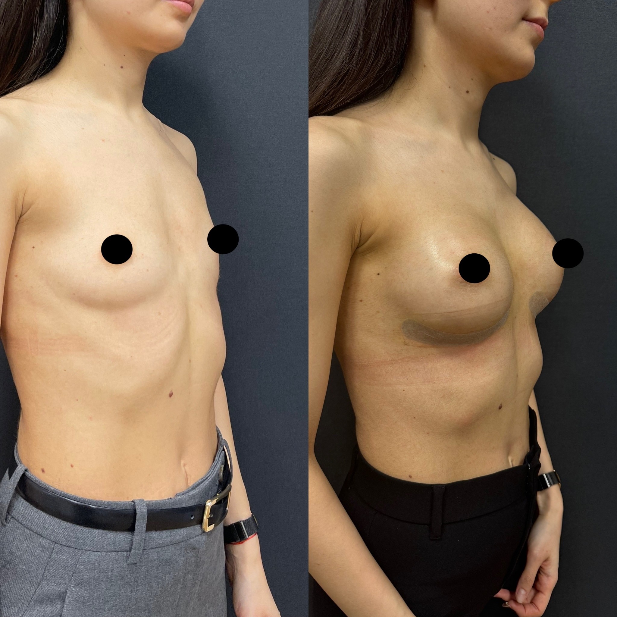 10 days breast augmentation result right oblique view