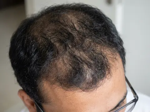hair loss and scalp faq
