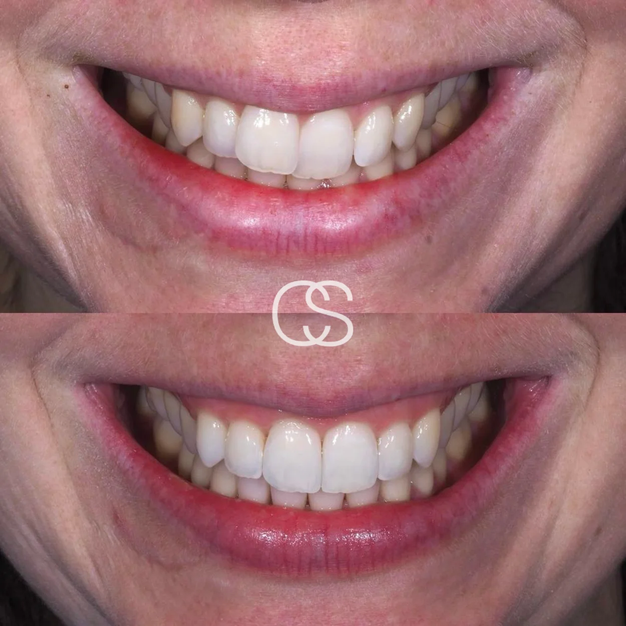 Before & After Clear aligners at Colac Smiles, Colac