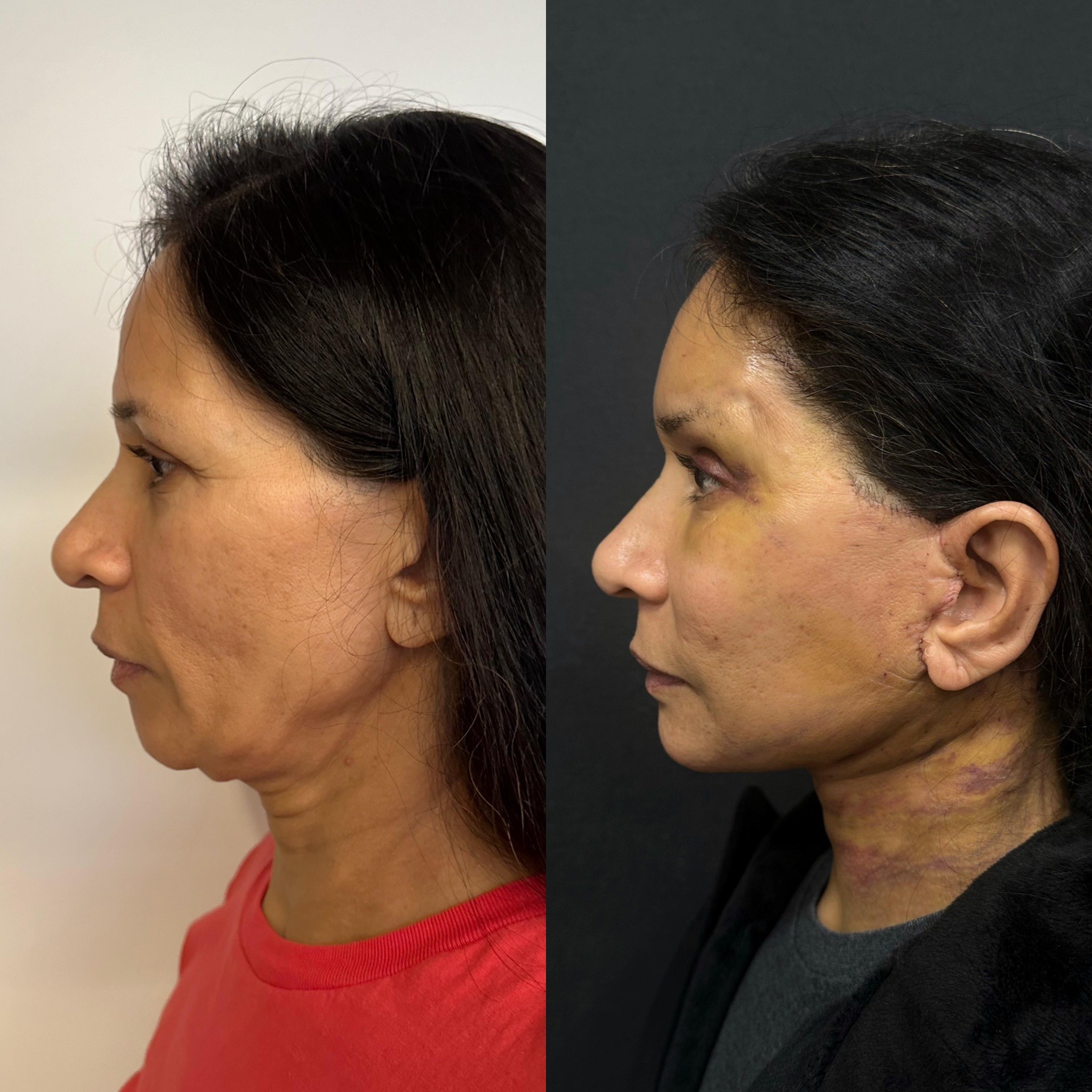 face neck lift deep plane and browlift 4 days post-op before after