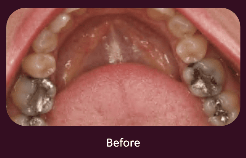 Dental Filling