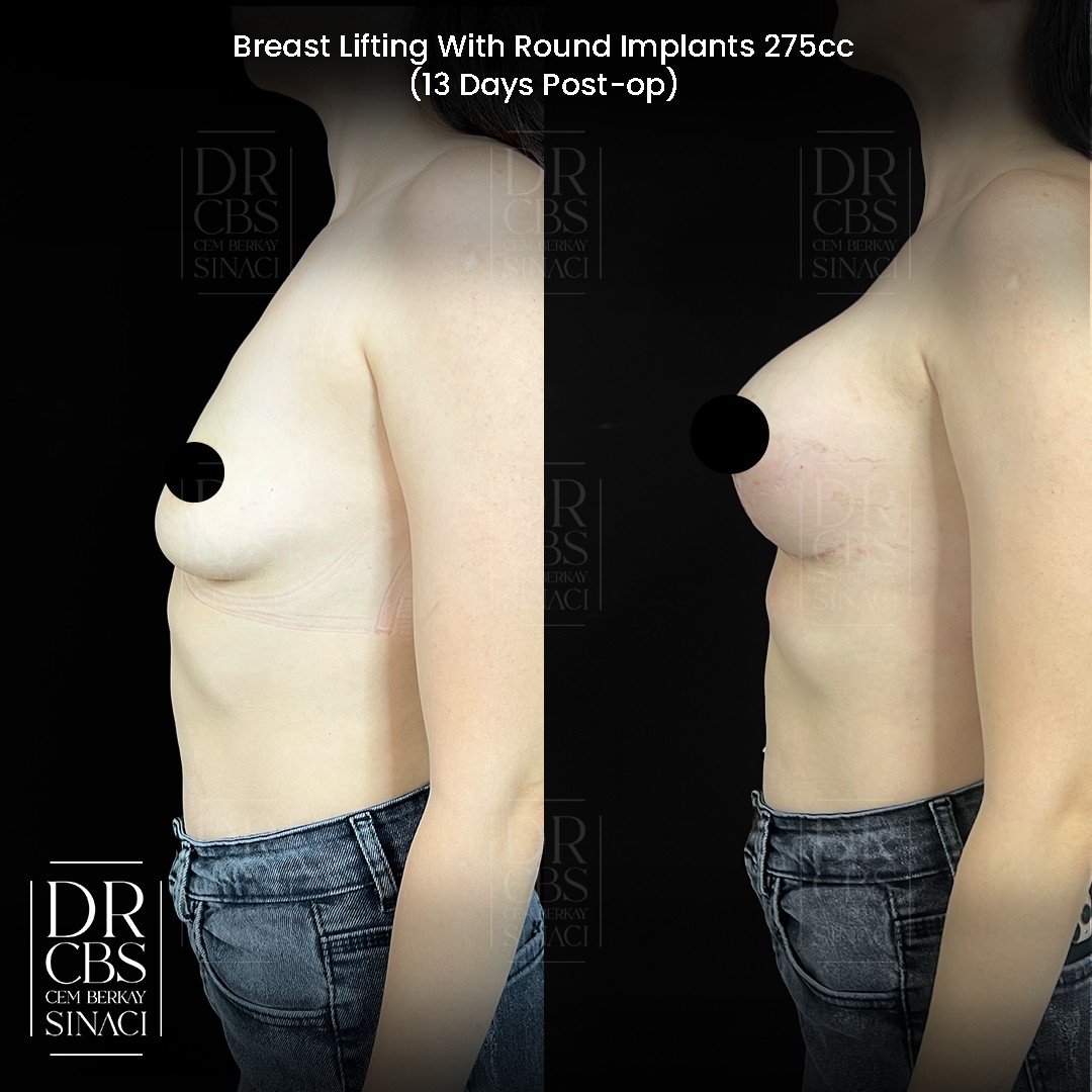 13 days before after breast lift with implant in Turkey side view