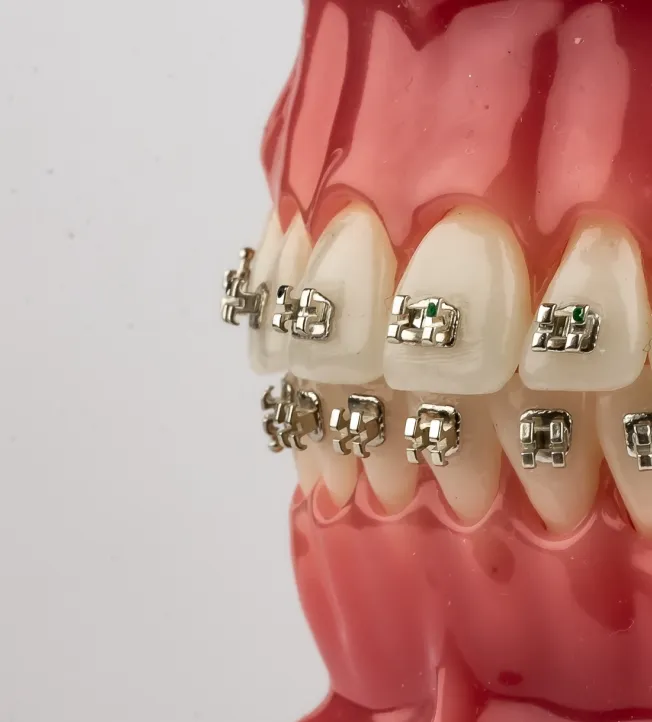 Zdjęcie prezentujące stały aparat na zęby