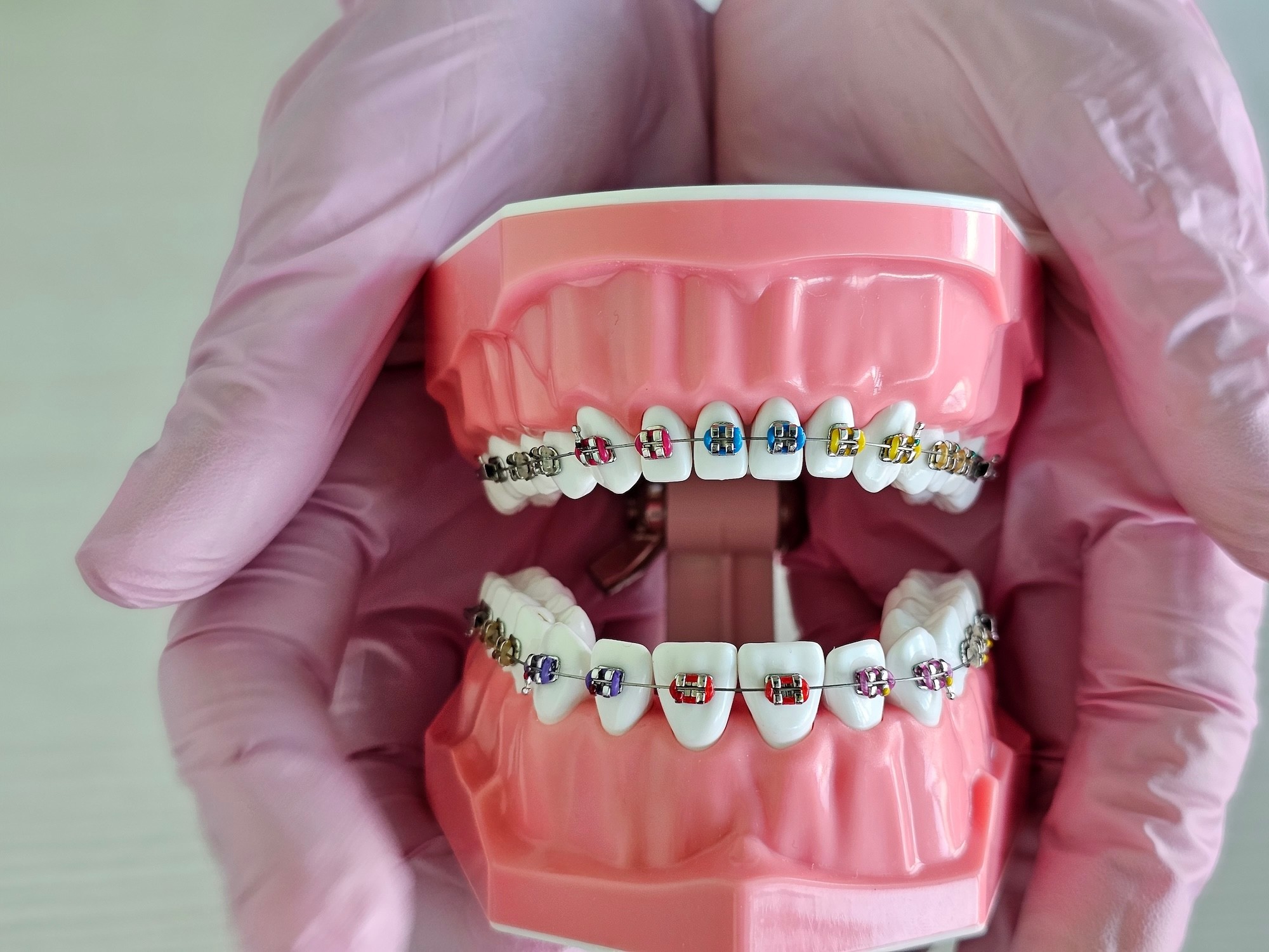 A young boy smiling with his braces