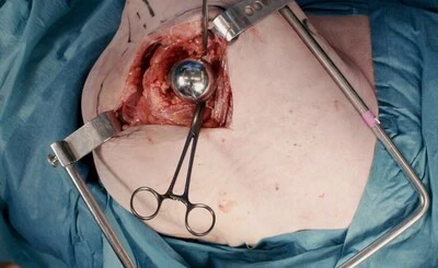 Hip hemiarthroplasty - Hardinge approach