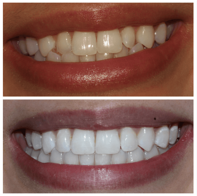 Before and After Whitening Treatment at ScarboroSmiles Dental Clinic in Scarborough, ON | Best dentist in Scarborough. 