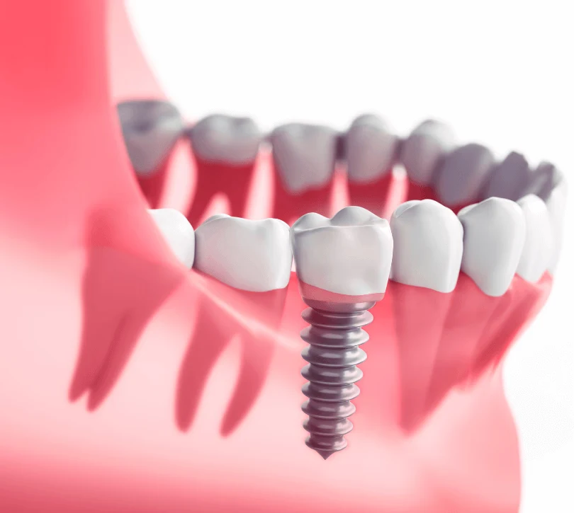 dental implants