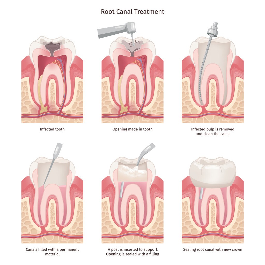 Steps in Root Canal Treatment