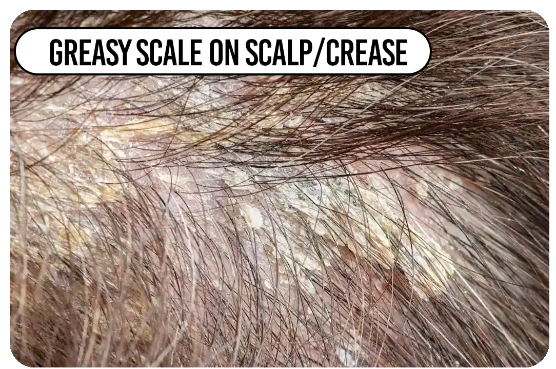 Greasy scale on scalp/crease