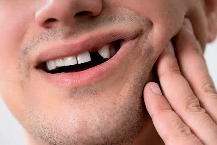 ¿Cuándo necesitas un Implante Dental?