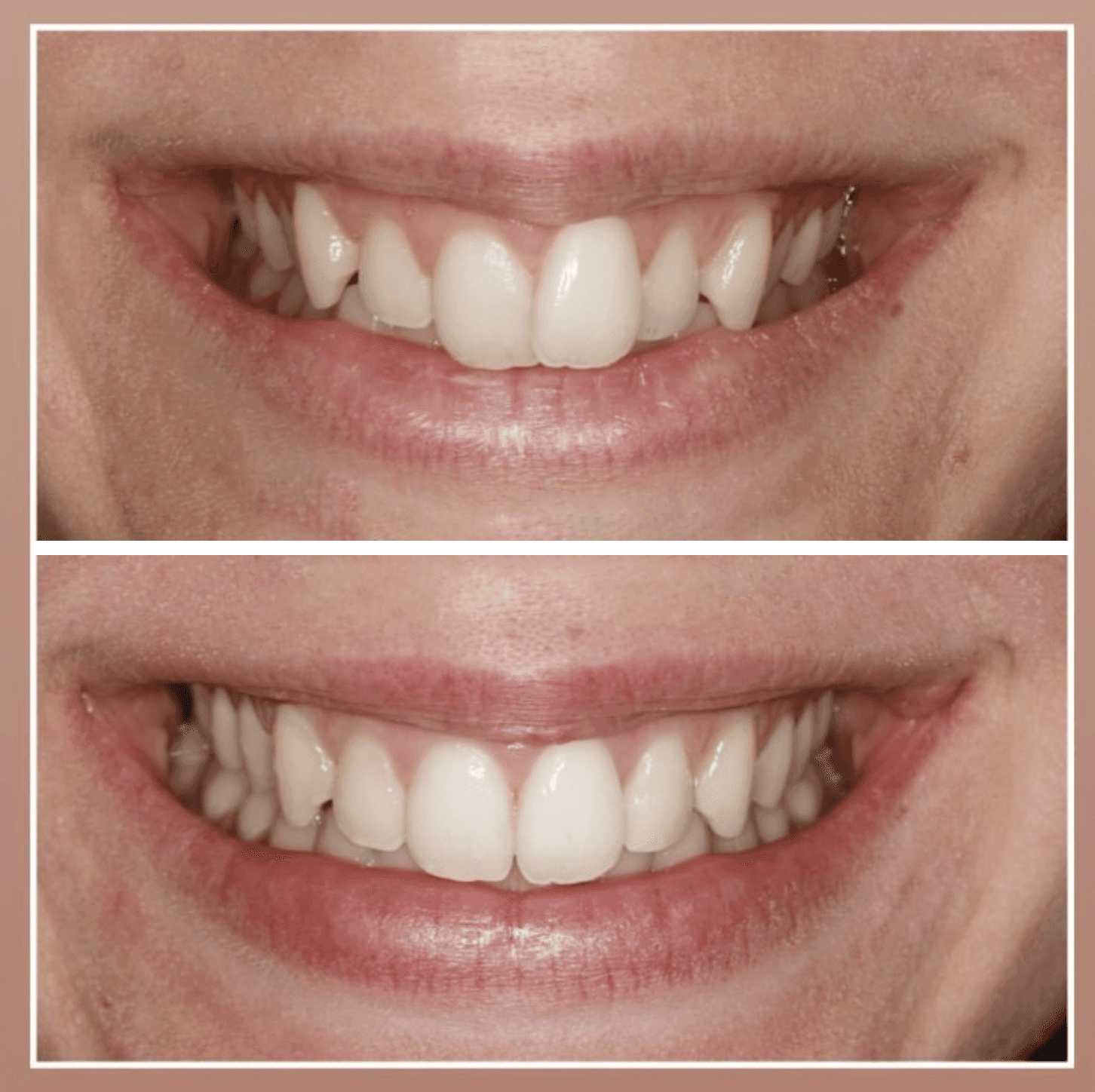 A female’s teeth with an invisalign before and after photo corrected from a misaligned to a straight smile at Invisalign Center.