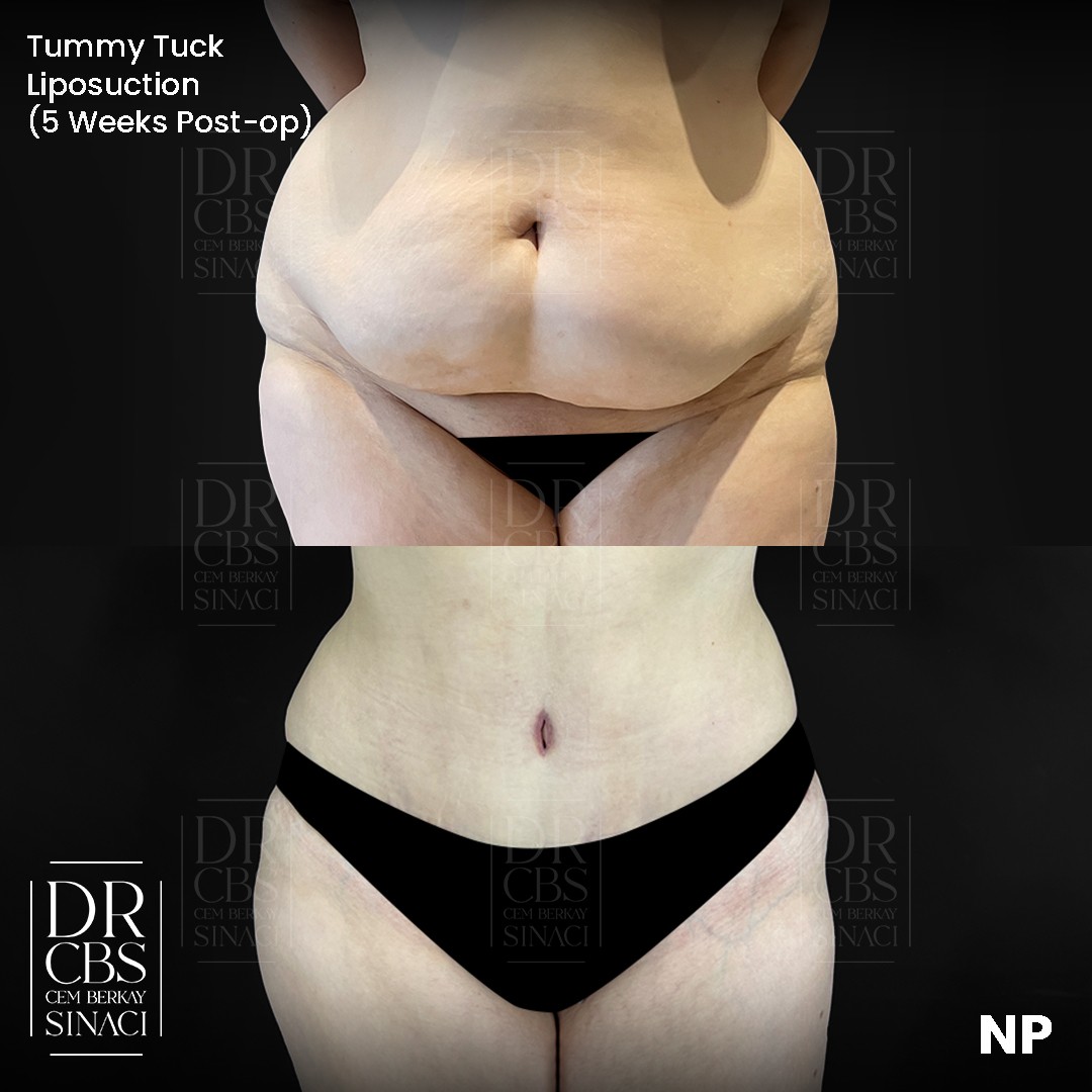 5 weeks before after photo of liposuction tummy tuck front view