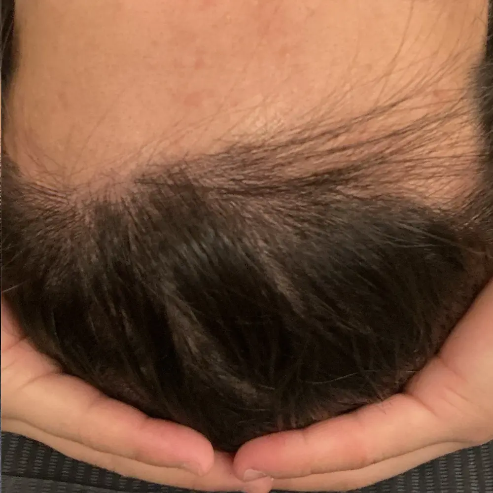 After men's hair loss treatment at The Vancouver Aesthetician — hairline visibly restored with noticeably thicker, fuller and darker hair growth achieved
