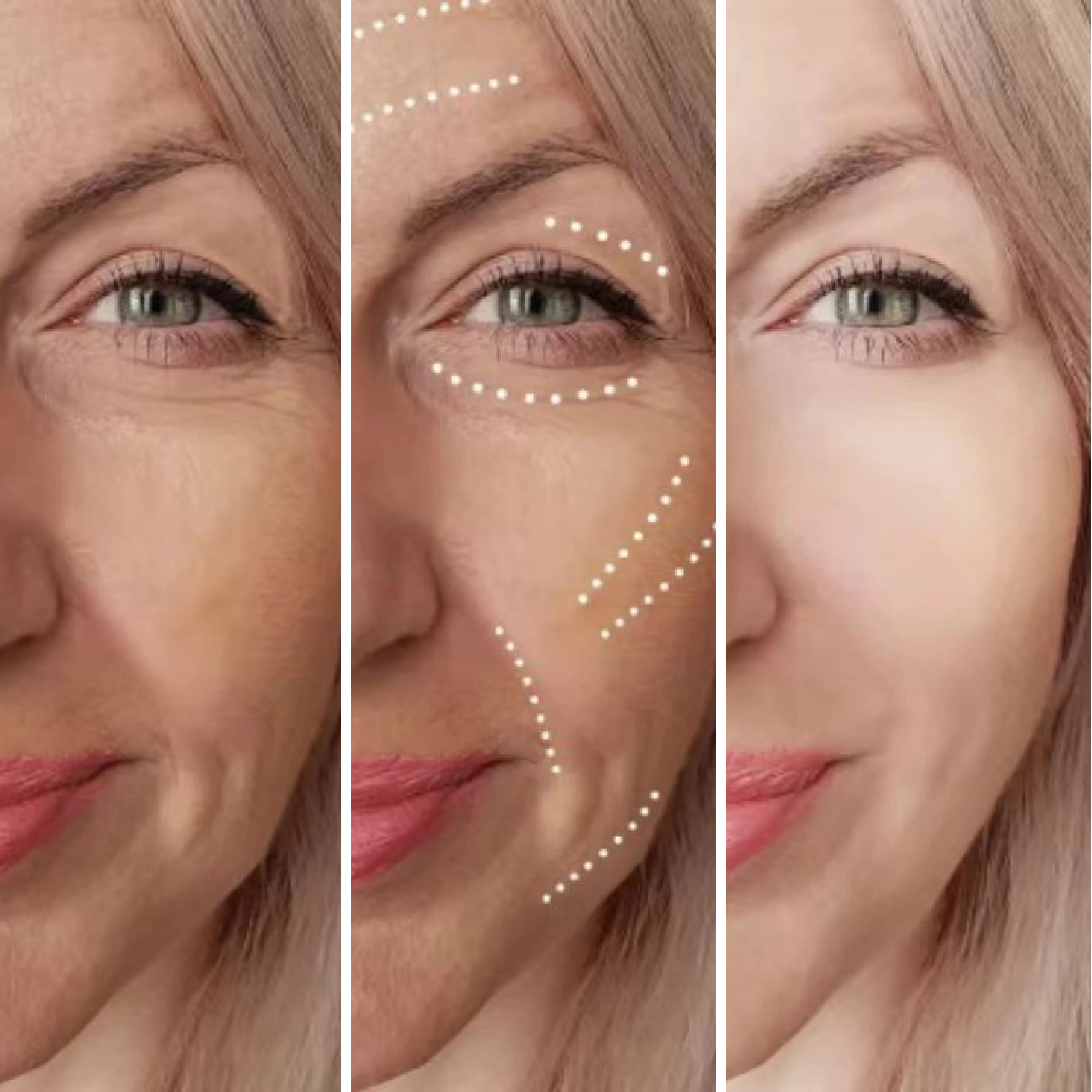 CaHA Injectable facial filler for facial contouring