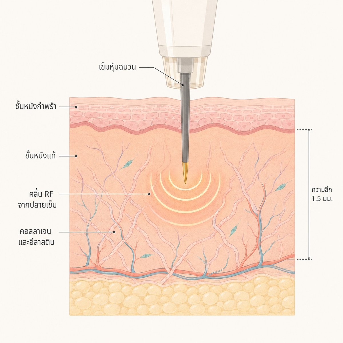 ภาพตัดขวางผิวหนังแสดงการทำงานของ Potenza RF Microneedling ที่ส่งพลังงานตรงถึงชั้นหนังแท้
