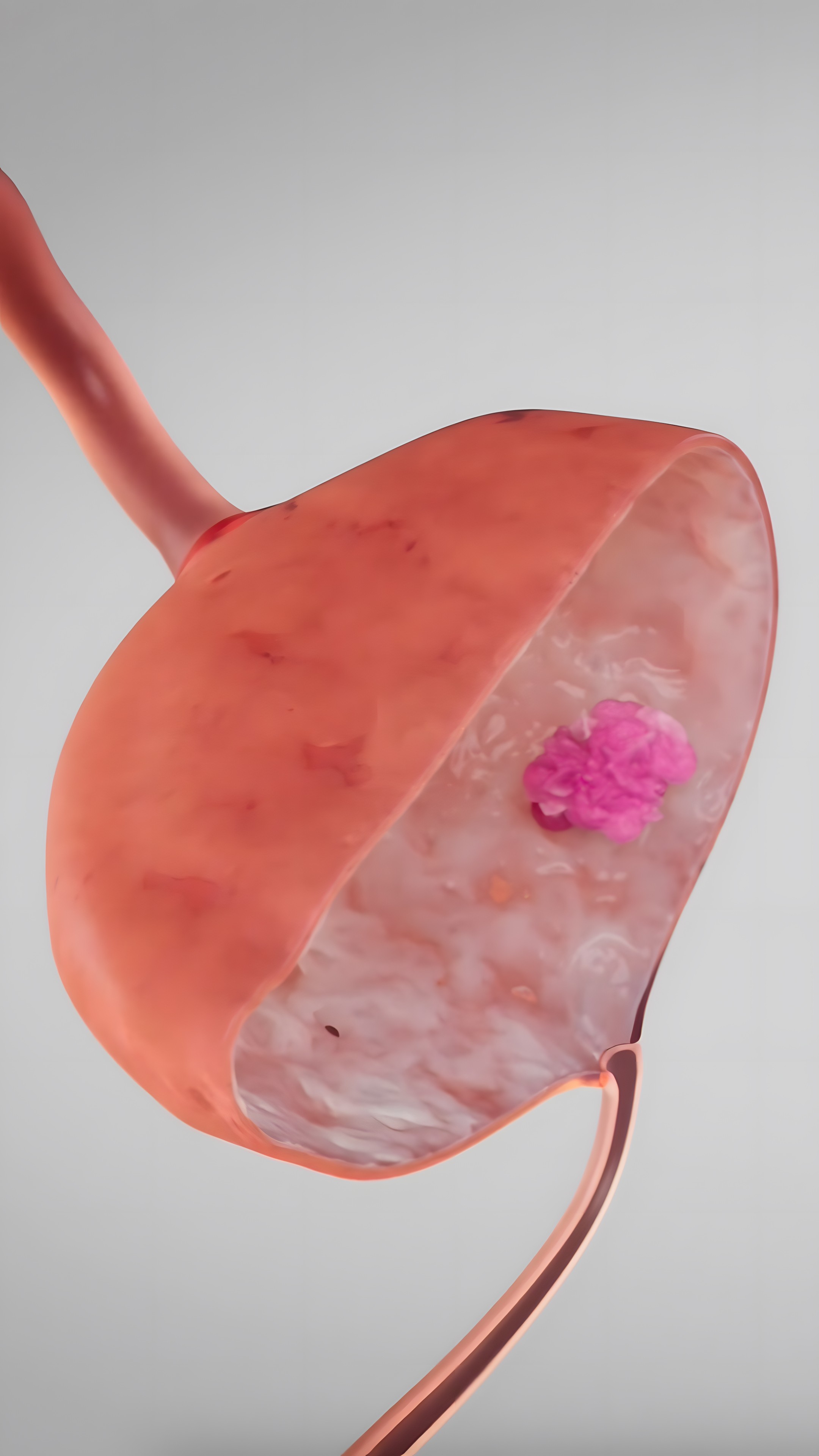 Schematic 3D visualization of the NMIBC tumor