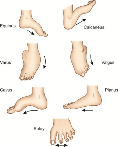 Illustration of Rare / Complex Foot Deformity