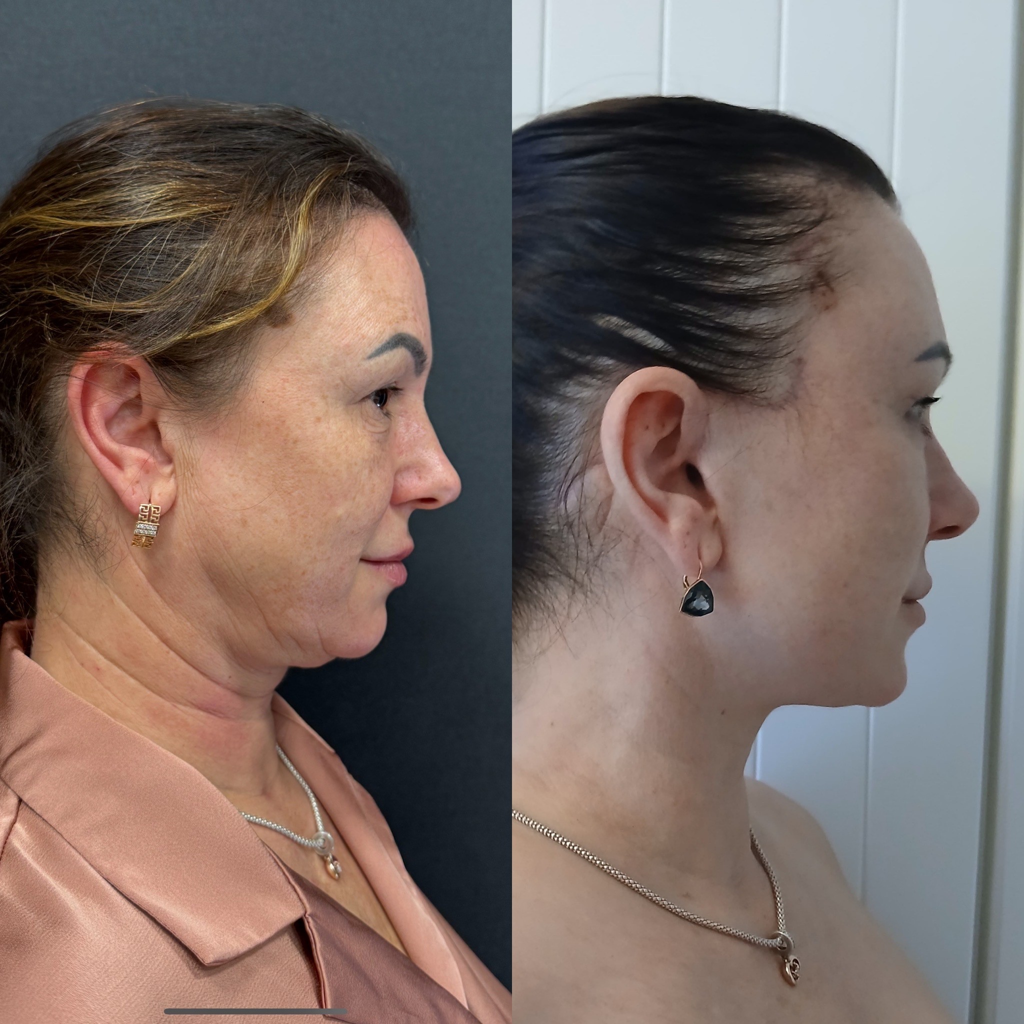 deep plane SMAS facelift before after side