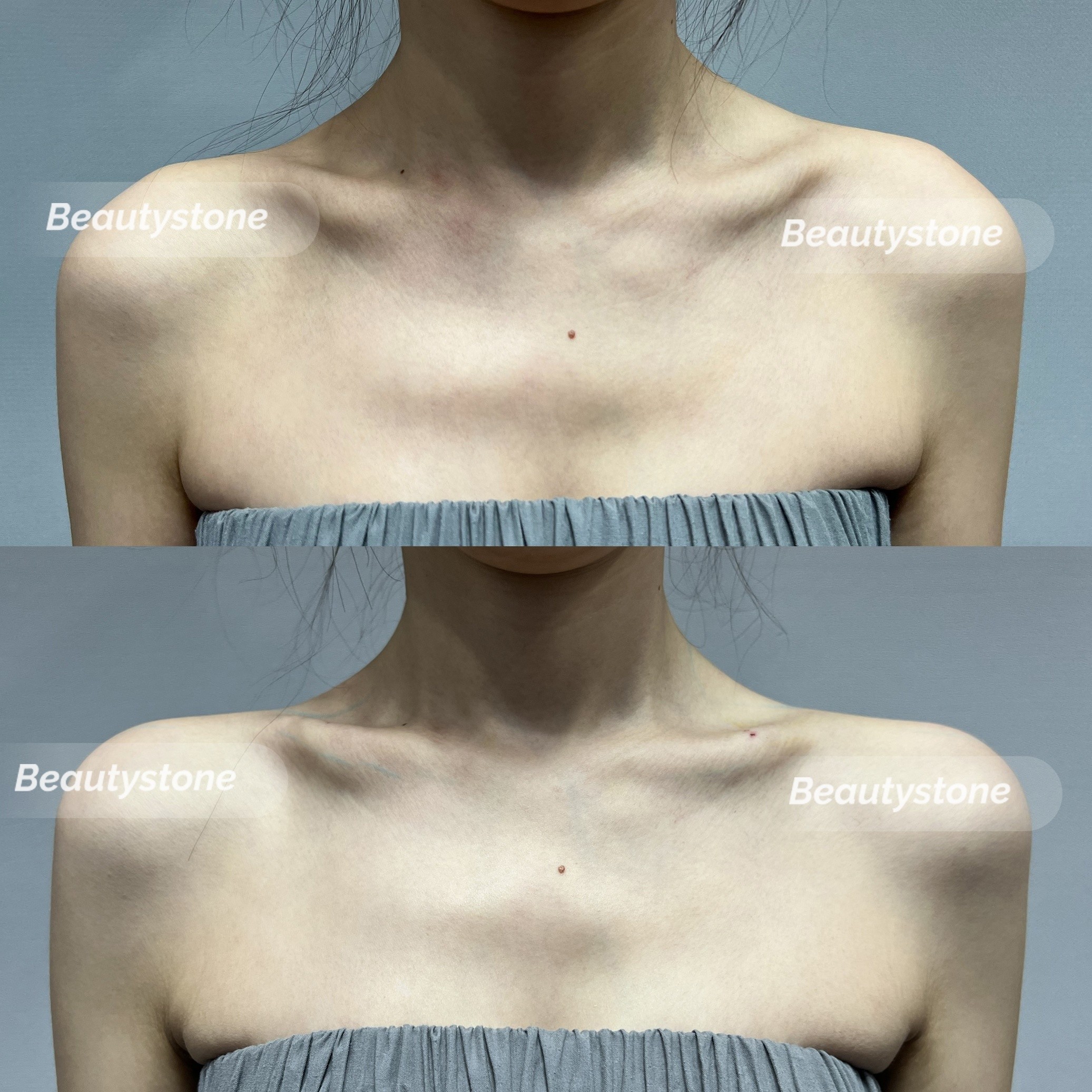 어깨필러의 중요성 홍대 바디필러