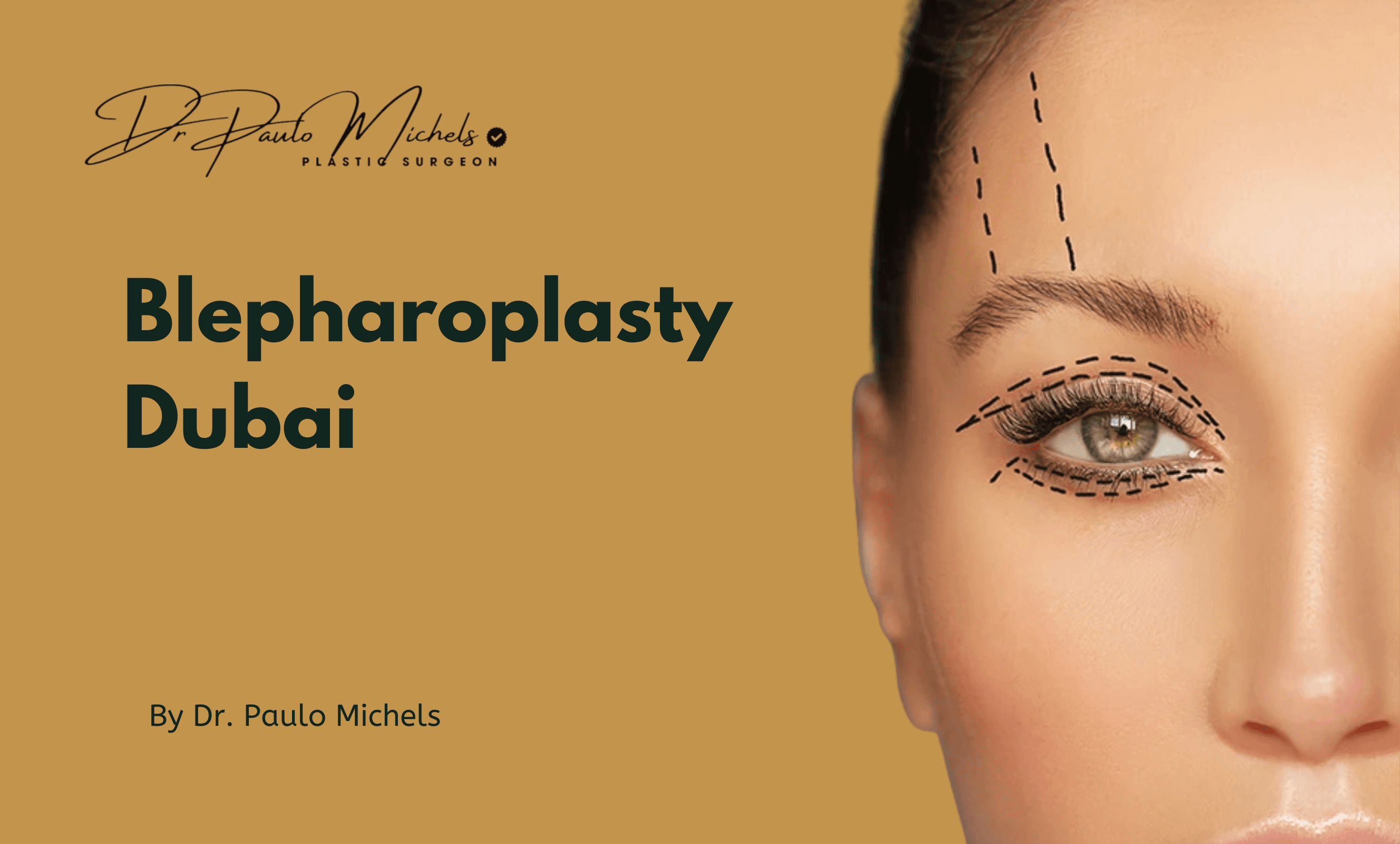 blepharoplasty-dubai