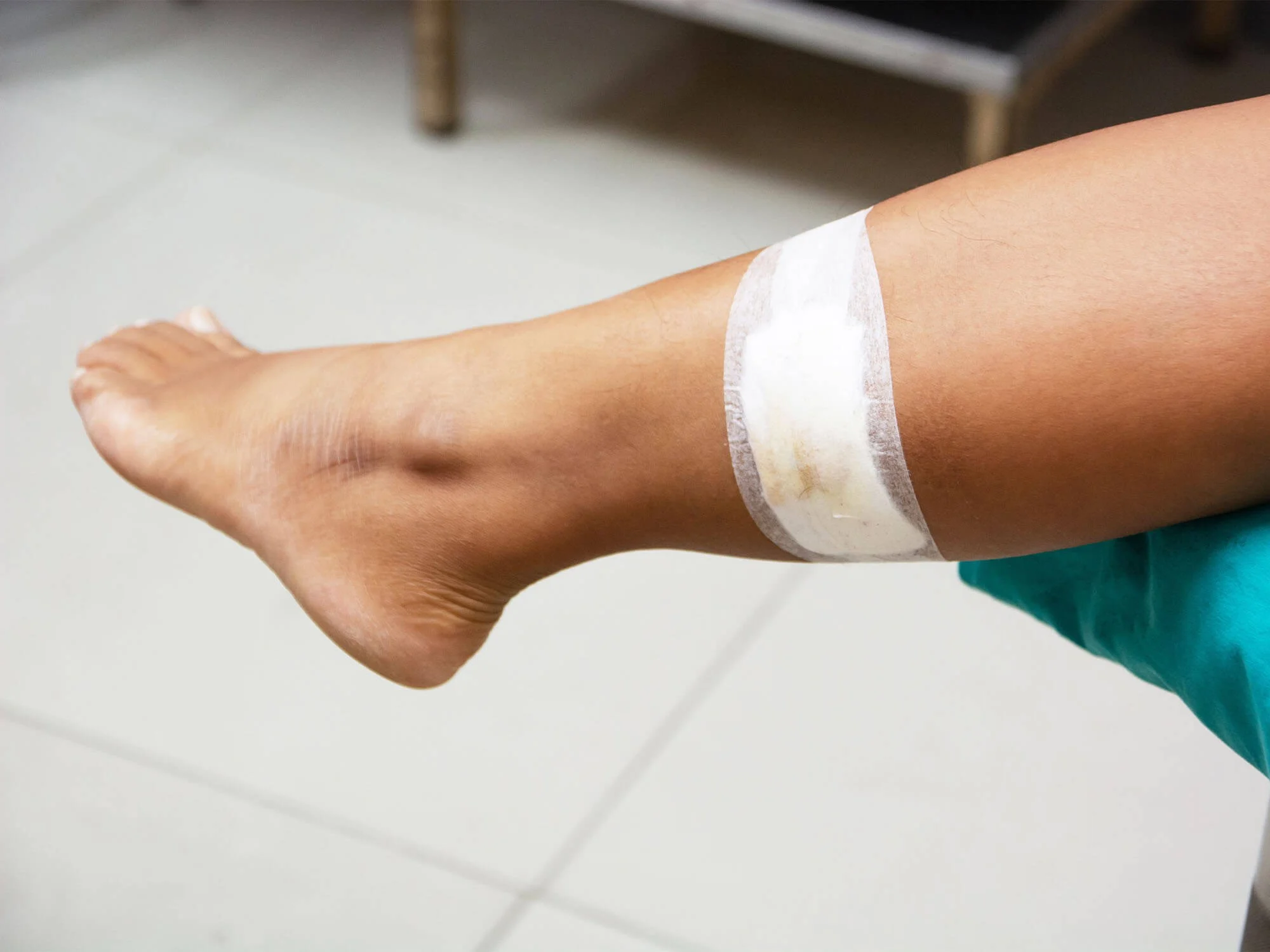 How Do You Treat Open Wounds on the Legs?