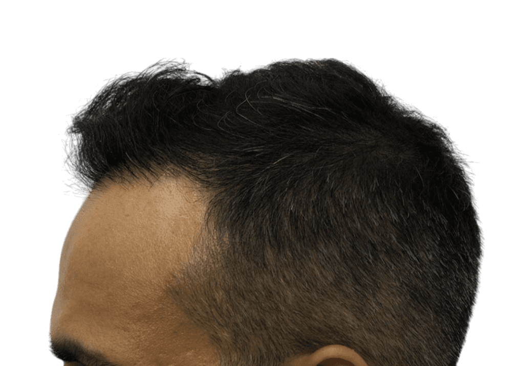 after FUE FUE Hair Transplant
