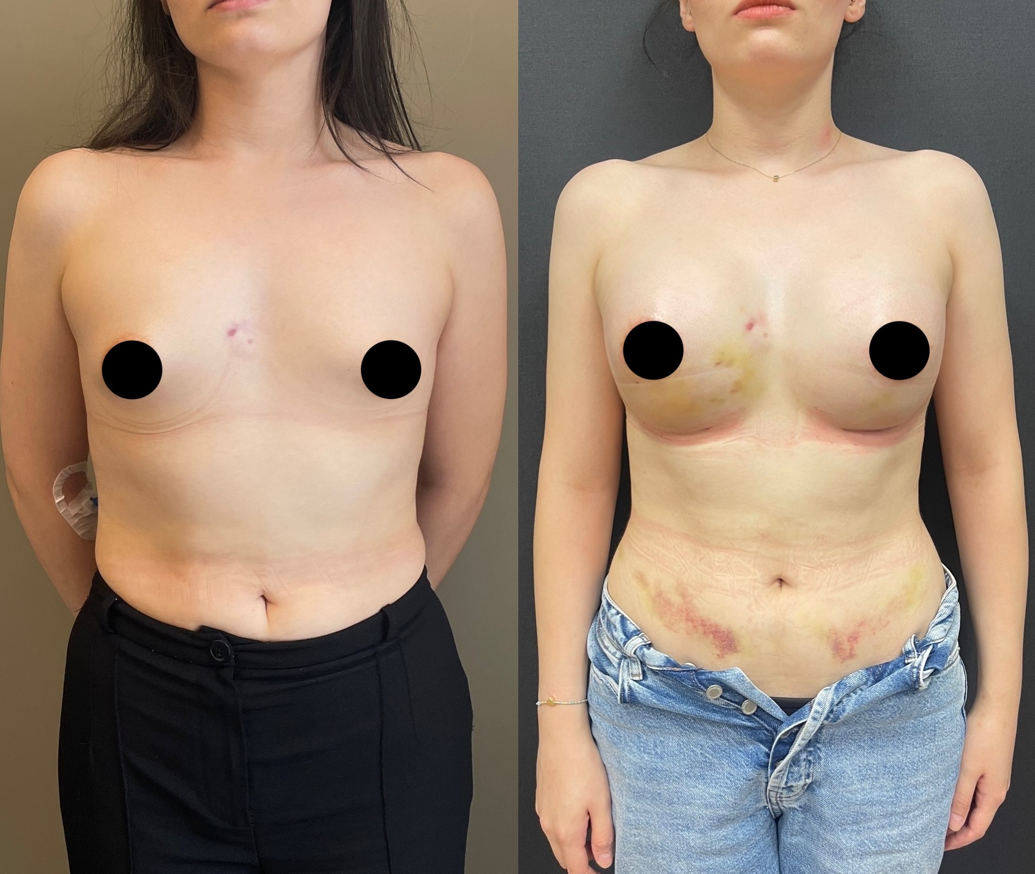 tuberous breast correction before after front view 5 days