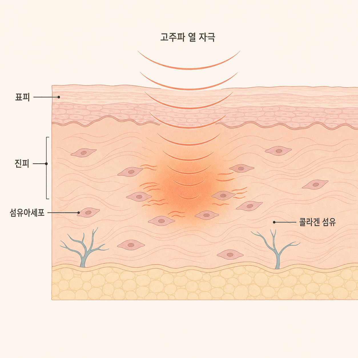 모노폴라 고주파가 진피층 섬유아세포를 자극해 콜라겐 재생을 유도하는 과정