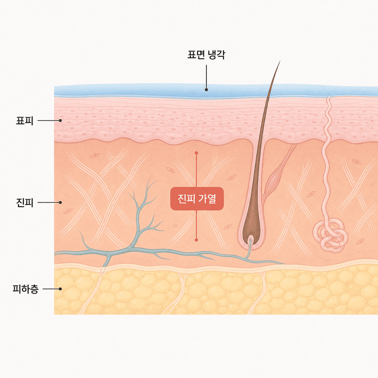 표면은 식히고 진피층만 데우는 구조