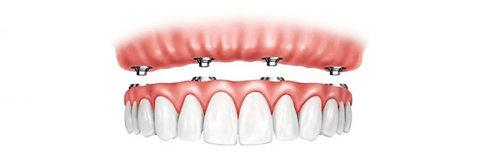 All-on-X full arch dental implants in Newark & Milltown NJ